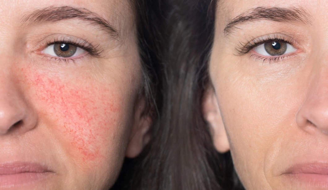 closeup portrait before after caucasian woman showing redness inflamed blood vessels her cheeks concept rosacea 651462 1012