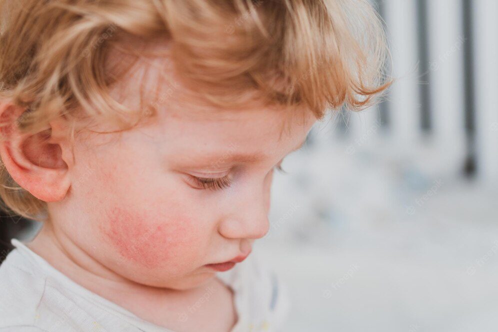 food allergy young child cheeks 130040 4091