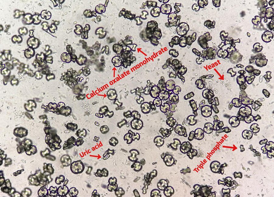 microscopic urinalysis showing calcium oxalate monohydrate uric acid triple phosphate crystal 595440 2328