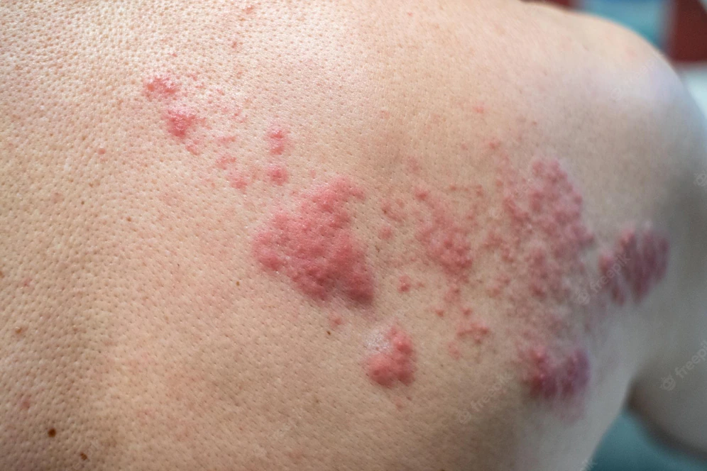 shingles disease herpes zoster varicellazoster virus skin rash blisters body 49071 7790