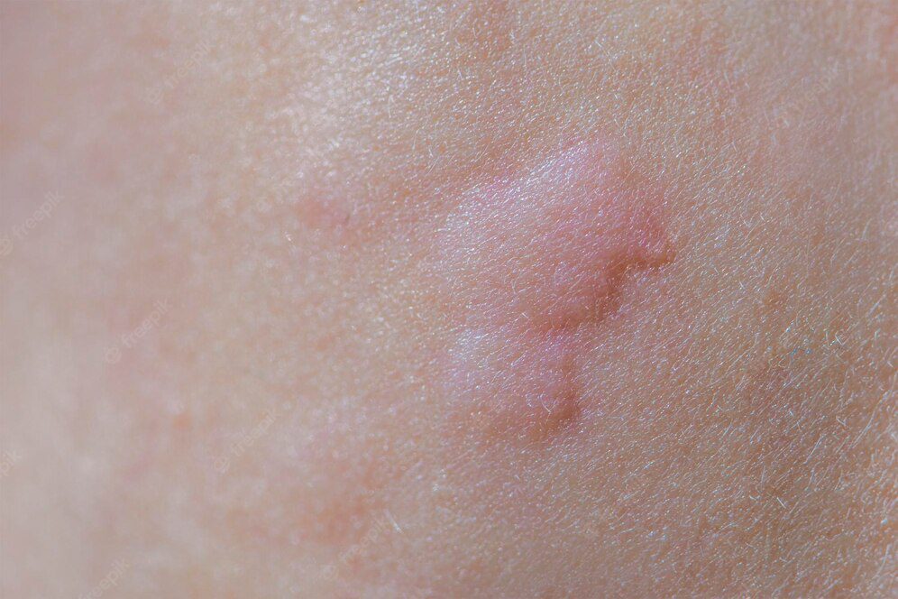 urticaria skin red spots allergic reaction skin child urticaria symptoms cl 418821 2513