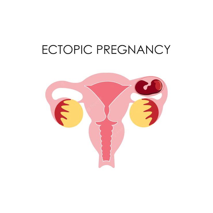anatomical drawing ectopic pregnancy female uterus 667176 213
