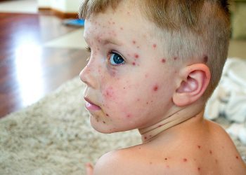 آبله مرغان چیست