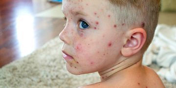 آبله مرغان چیست