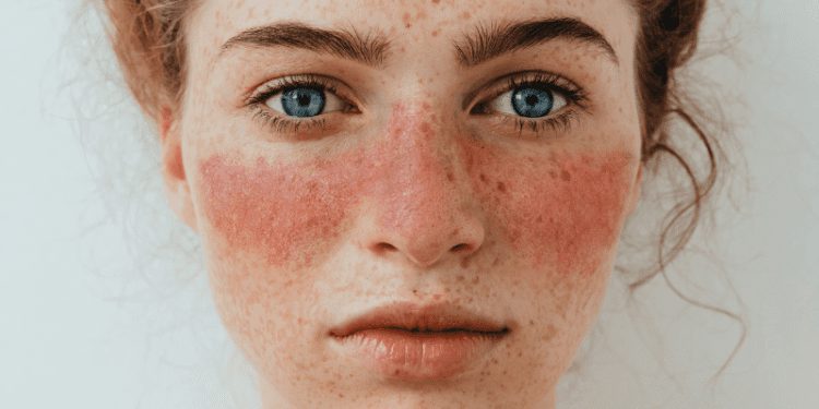 لوپوس یک بیماری خود ایمنی مزمن 1 لوپوس