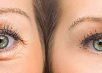 بلفاروپلاستی (جراحی پلک) چیست؟