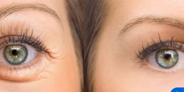 بلفاروپلاستی (جراحی پلک) چیست؟