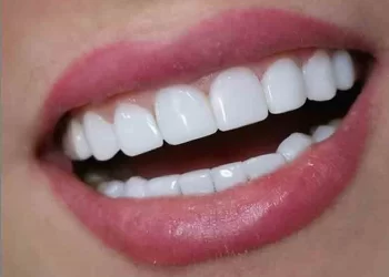 کاشت دندان و زیبایی