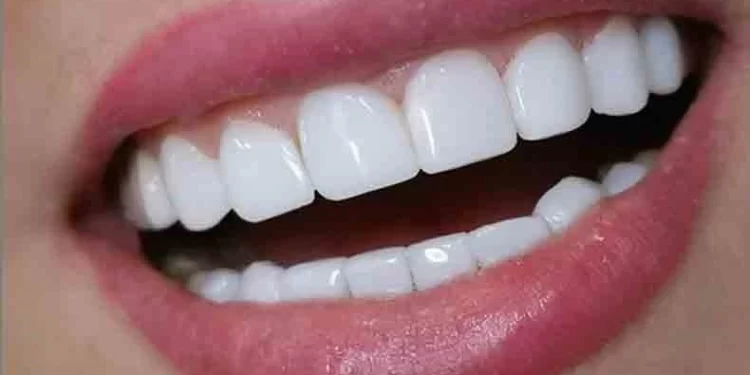 کاشت دندان چیست؟ مراحل و مزایای آن 1 کاشت دندان و زیبایی