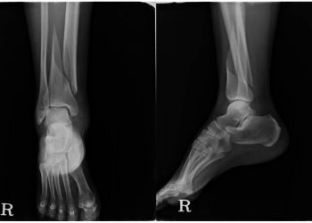 درمان شکستگی مچ پا