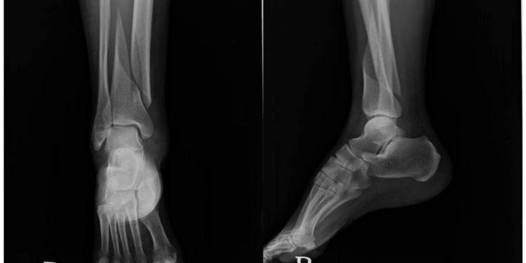 درمان شکستگی مچ پا چقد زمان میبرد؟ 1 درمان شکستگی مچ پا