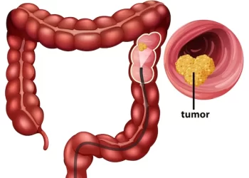 سرطان روده بزرگ سرطان کولورکتال