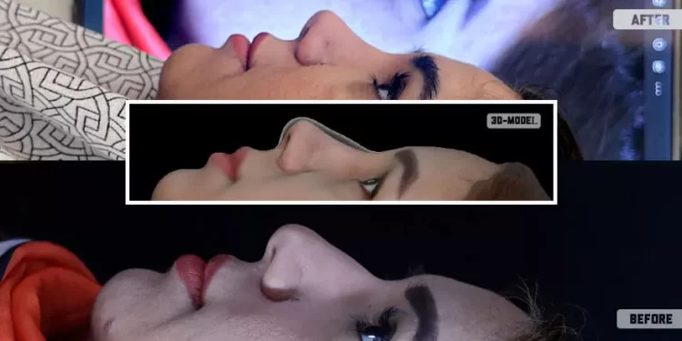 اطلاعات کامل درباره لیفت بینی و تاثیرات آن بر زیبایی چهره 1 اطلاعات کامل درباره لیفت بینی و تاثیرات آن بر زیبایی چهره