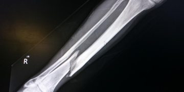 مراقبت های بعد از شکستگی پا