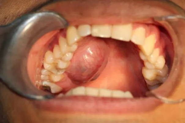 Tooth cyst1