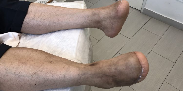 هر آنچه باید در مورد قطع عضو بدانید 1 قطع عضو