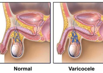 بهترین دکتر واریکوسل در تهران