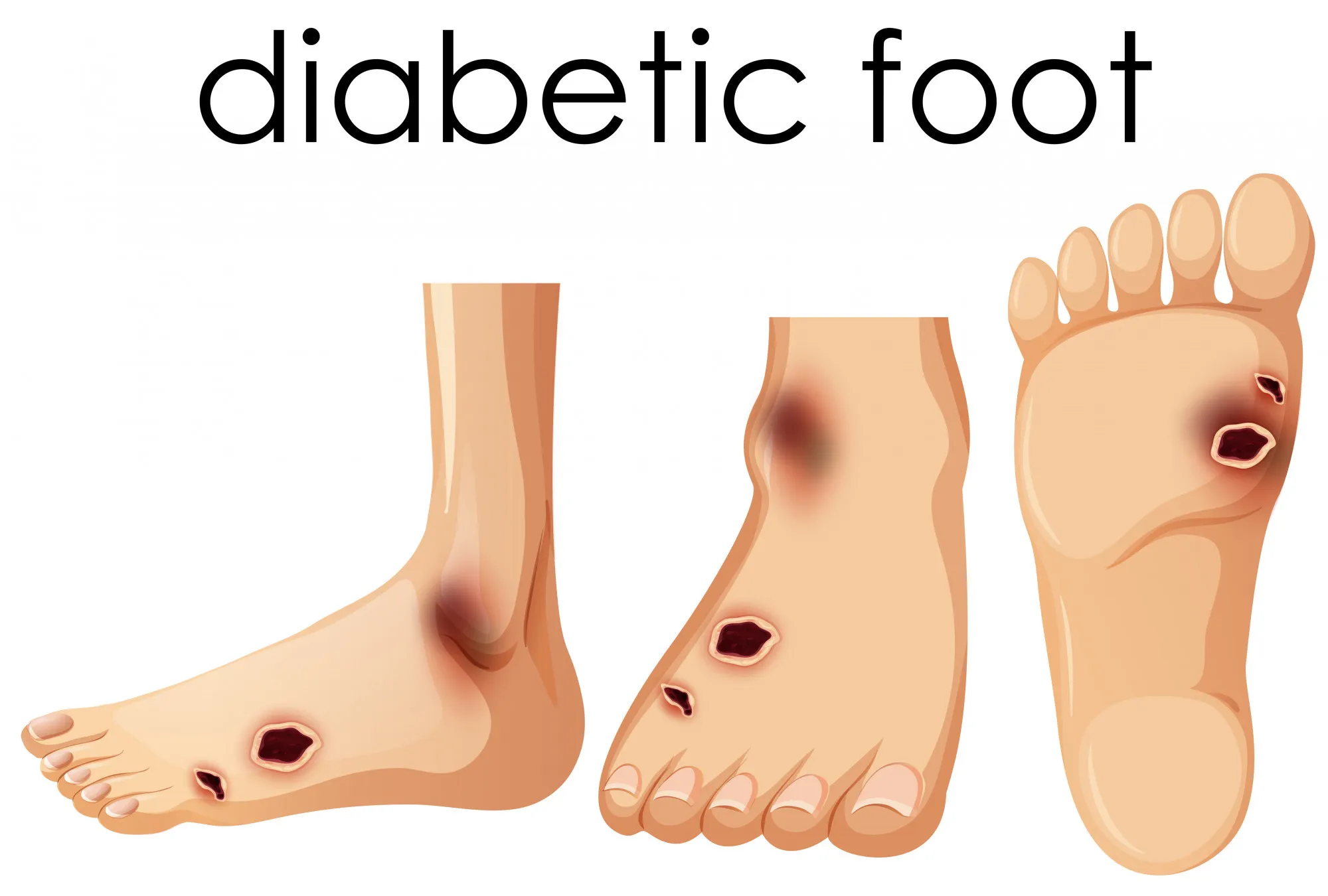 human foot with diabetic 1308 15 1