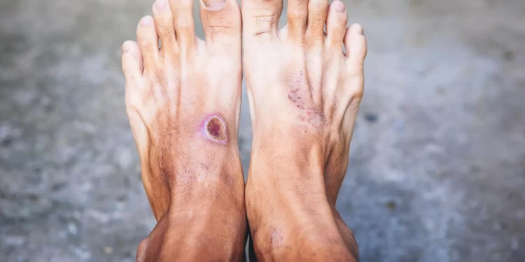 زخم پای دیابتی 1 زخم پای دیابتی