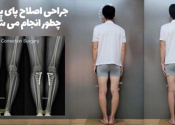 جراحی پای پرانتزی در بزرگسالان