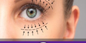 زمان بهبود عمل بلفاروپلاستی