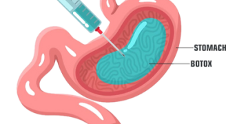 تزریق بوتاکس معده