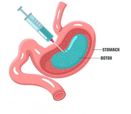 بوتاکس معده و بالون معده، دو روش جدید برای تناسب اندام و لاغری سریع 1 تزریق بوتاکس معده