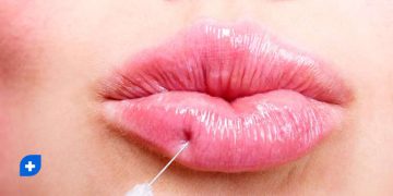 5 نکته مهم برای بوسیدن بعد از تزریق ژل لب