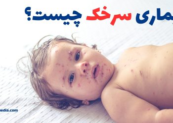 بیماری سرخک چیست