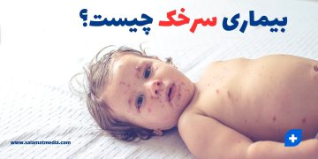 بیماری سرخک چیست