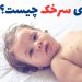 بیماری سرخک | بسیار مسری و گاه خطرناک 10 بیماری سرخک چیست