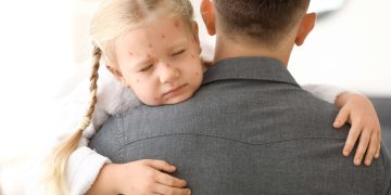 علائم آبله مرغان در سنین مختلف ؛ روش درمان آبله مرغان، بیماری شایع کودکی