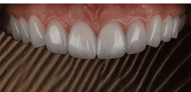 روش لیرینگ کامپوزیت چیست؟ - سلامت مدیا