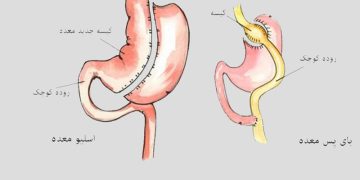اسلیو معده یا بای پس؛ بالاخره کدام بهتر است؟