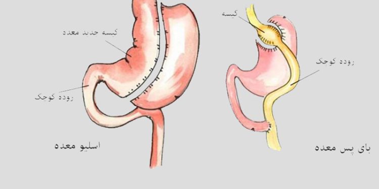 اسلیو معده یا بای پس؛ بالاخره کدام بهتر است؟ 1 اسلیو معده یا بای پس؛ بالاخره کدام بهتر است؟