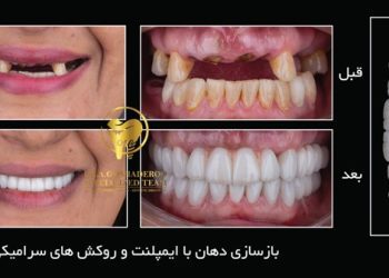 ایمپلنت دیجیتال در تهران