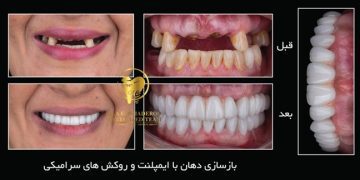 ایمپلنت دیجیتال در تهران