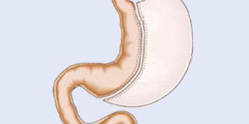 با اسلیو معده انقلابی بزرگ در زندگی شما ایجاد می شود!