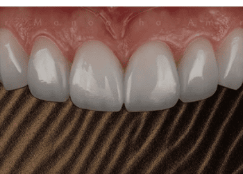 روش لیرینگ کامپوزیت چیست؟ - تصویر 1