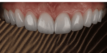 روش لیرینگ کامپوزیت چیست؟ - تصویر 1