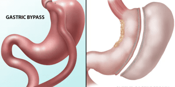 مقایسه بای پس معده و اسلیو معده_ کدام روش برای کاهش وزن موثرتر است؟