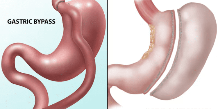 مقایسه بای پس معده و اسلیو معده: کدام روش برای کاهش وزن موثرتر است؟ 1 مقایسه بای پس معده و اسلیو معده_ کدام روش برای کاهش وزن موثرتر است؟