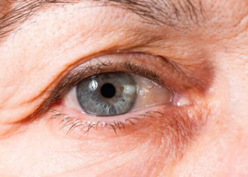 درمان قطعی چروک دور چشم با روش‌های خانگی