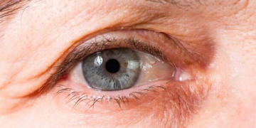 درمان قطعی چروک دور چشم با روش‌های خانگی