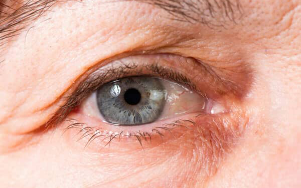 درمان قطعی چروک دور چشم با روشهای خانگی 1 درمان قطعی چروک دور چشم با روشهای خانگی