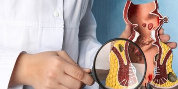 درمان بیرون زدگی بواسیر - تصویر 1