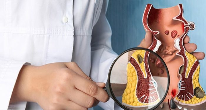 برای درمان بیرون زدگی بواسیر چه باید کرد؟ 1 درمان بیرون زدگی بواسیر - تصویر 1