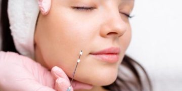 مدت زمان جذب نخ لیفت