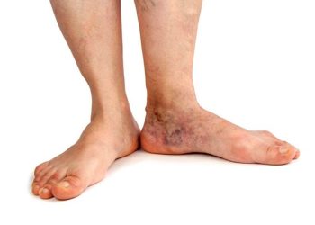 واریس در زنان و مردان - واریس مچ پا علت و درمان واریس مچ پا و کف پا دکتر مهرداد اقدسی