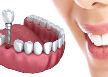 درصد موفقیت ایمپلنت فوری چقدر است